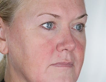 Model with Sensitive Skin