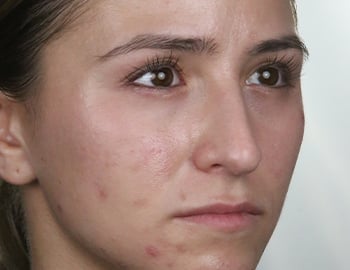 Model with Oily Skin Type